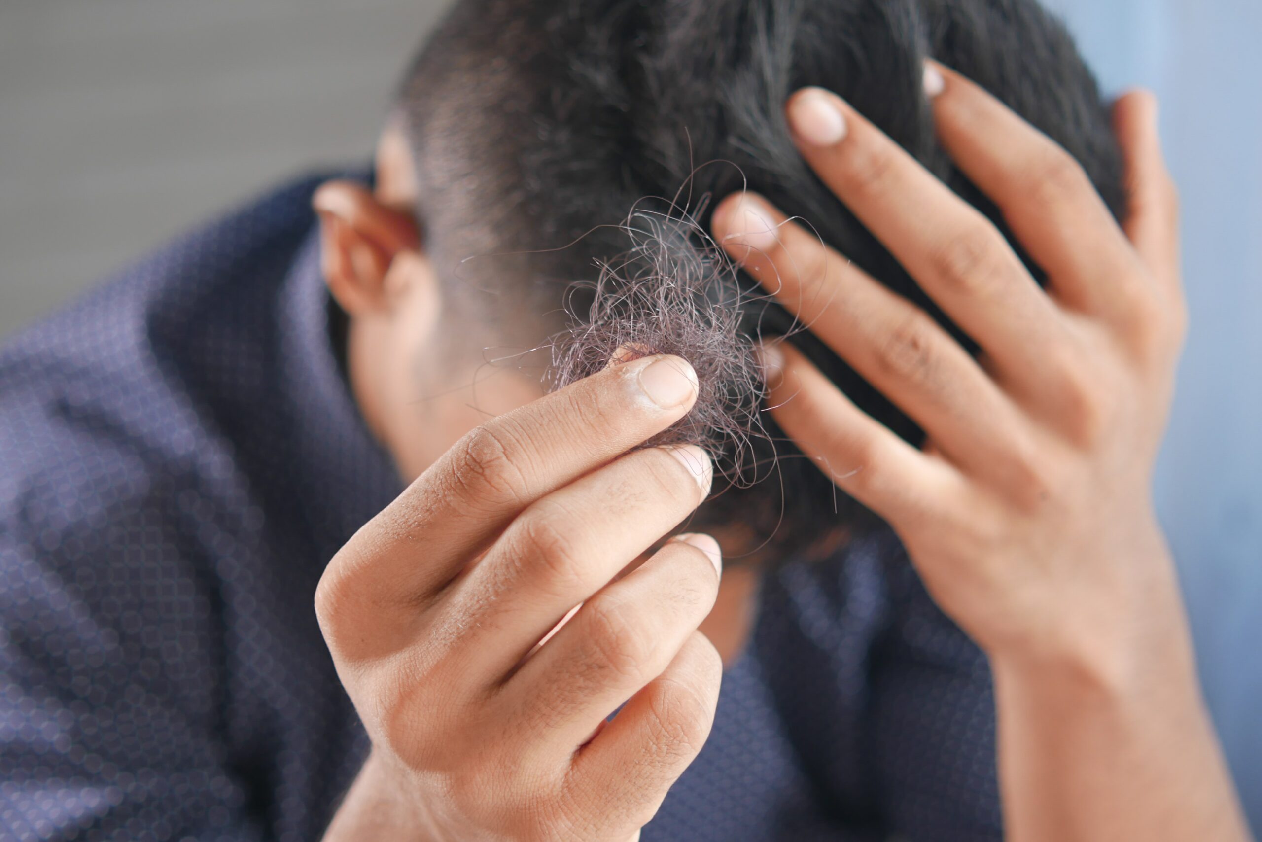 hair loss in twenties