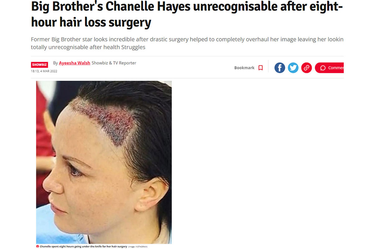 Big Brothers Chanelle Hayes unrecognisable after eight-hour hair loss surgery