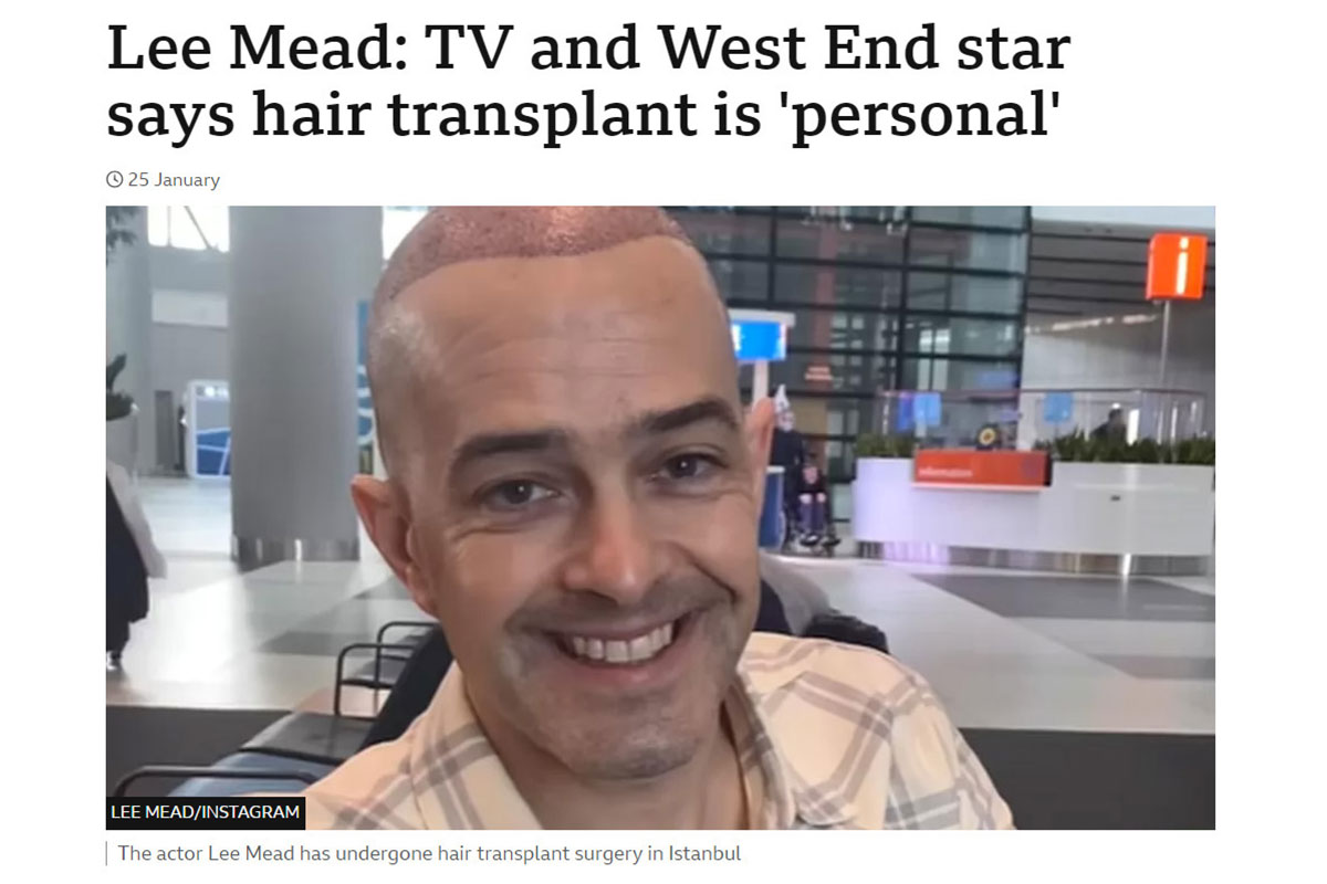 Lee Mead: TV and West End star says hair transplant is personal