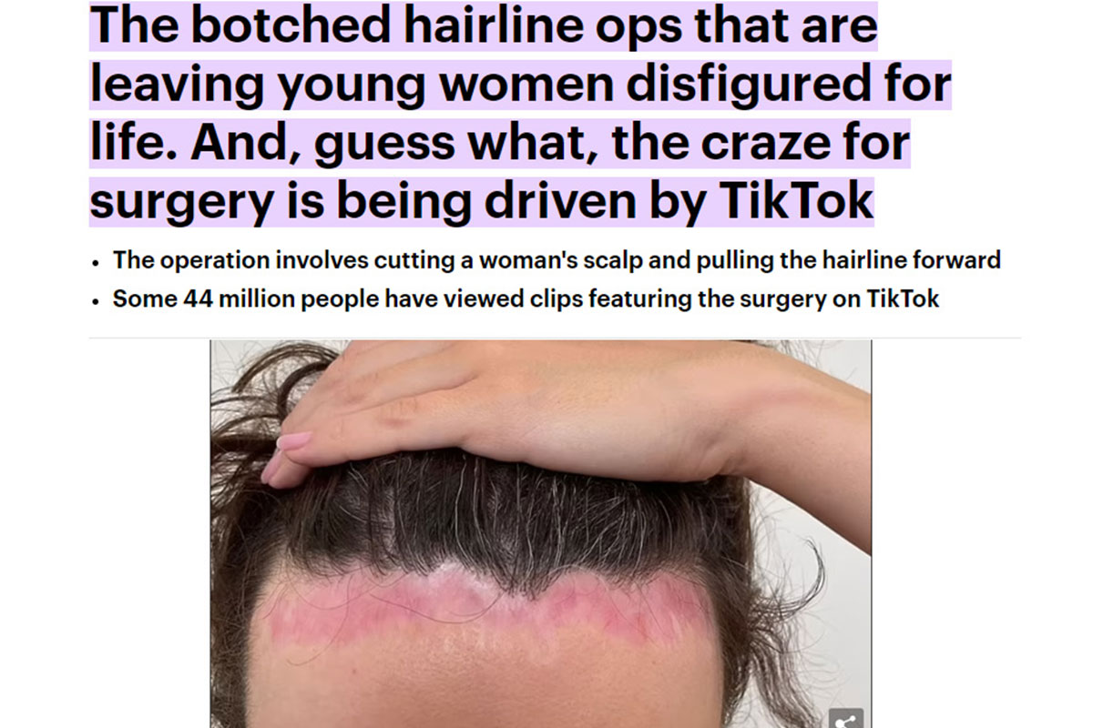 The botched hairline ops that are leaving young women disfigured for life
