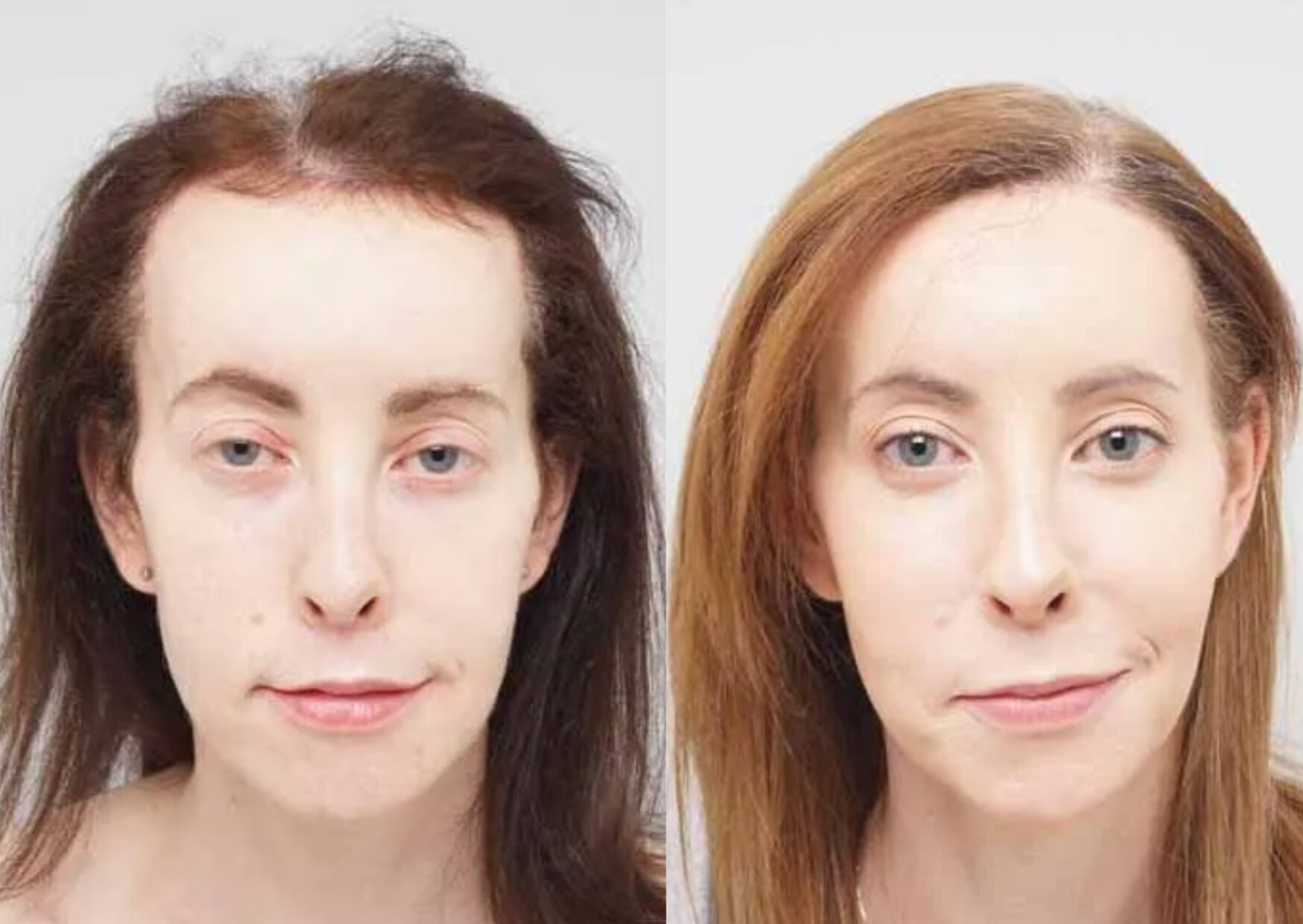 Side-by-side comparison of a transgender woman before and after hair transplant surgery, showing a visibly fuller and more feminised hairline post-procedure.
