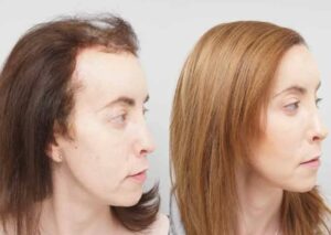 Side-by-side comparison of a transgender woman before and after hair transplant surgery, showing a visibly fuller and more feminised hairline post-procedure.
