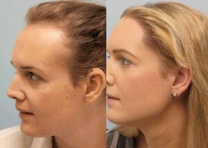 Samantha Pearsall hair transplant before and after photo showing a visibly fuller and more feminised hairline post-procedure.