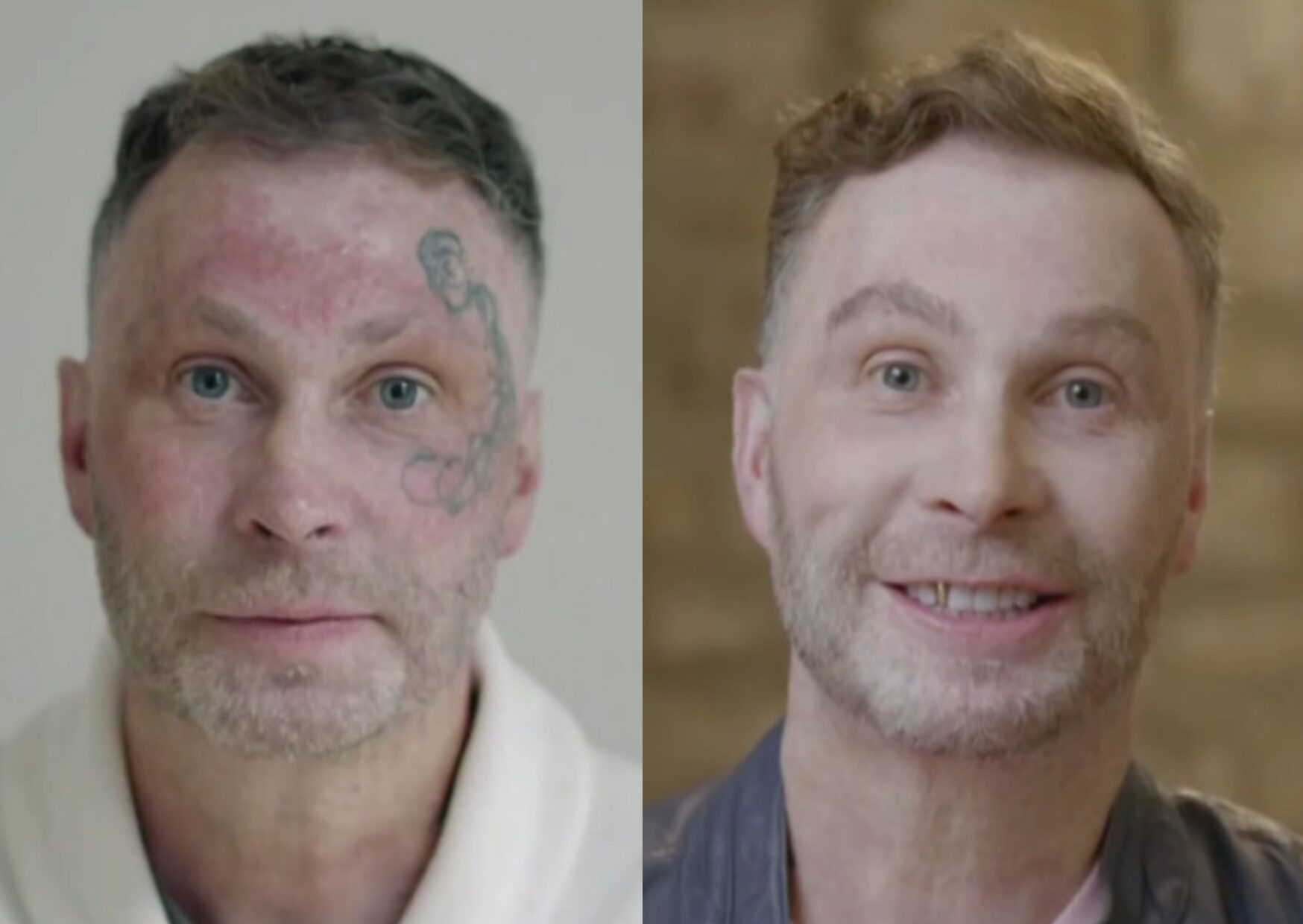 Before and after images of Terry Dunnage showing his transformation following facial reconstructive and hair restoration procedures.