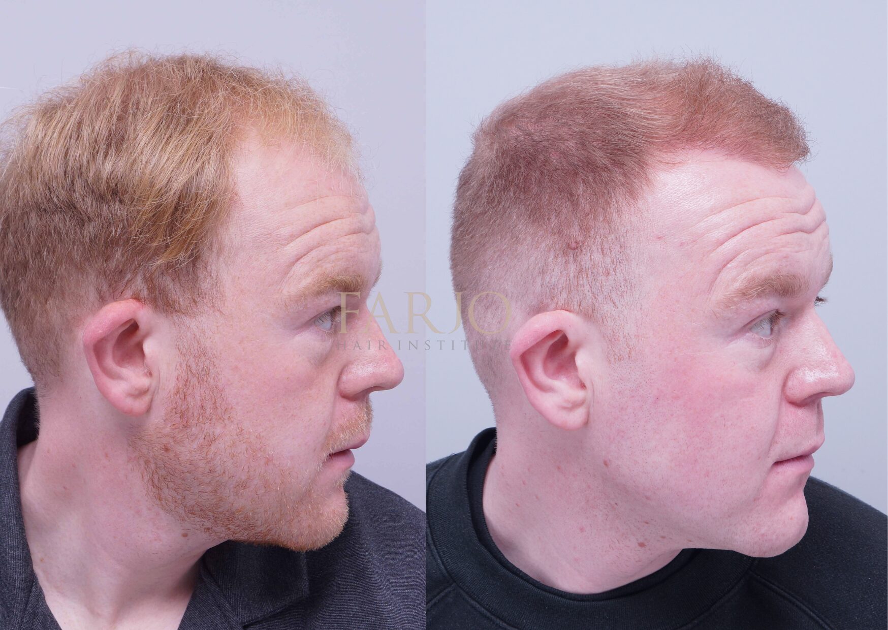 Colson Smith before and after hair transplant at Farjo Hair Institute
