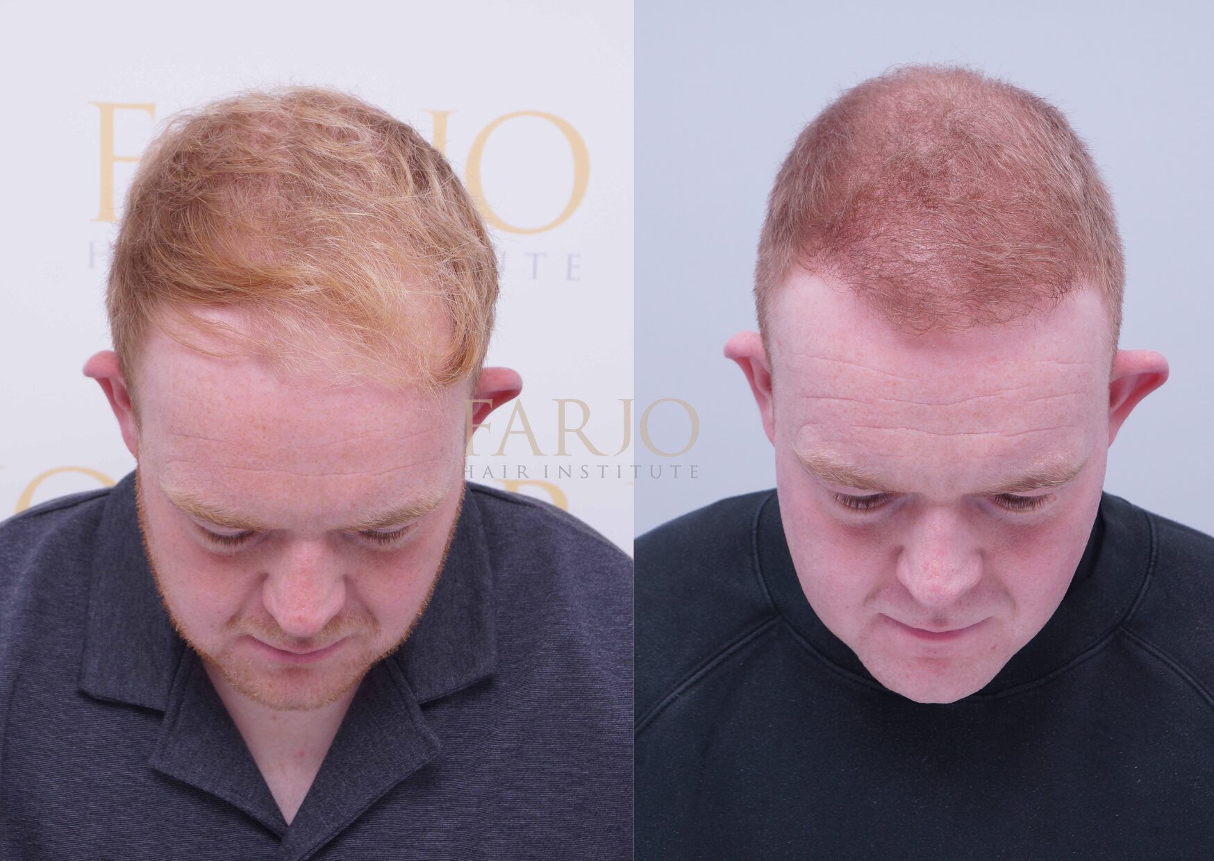  Colson Smith before and after hair transplant at Farjo Hair Institute