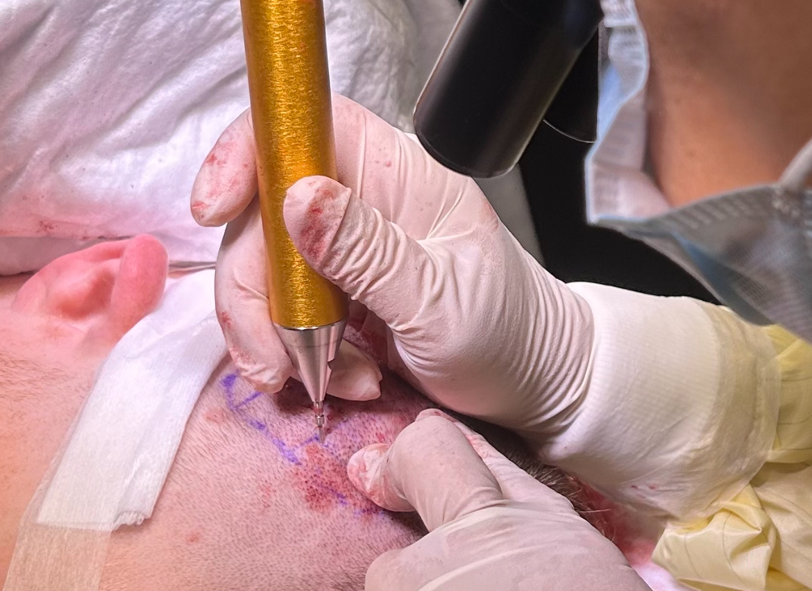 Dr Bessam Farjo performing hair transplant on Colson Smith at Farjo Clinic