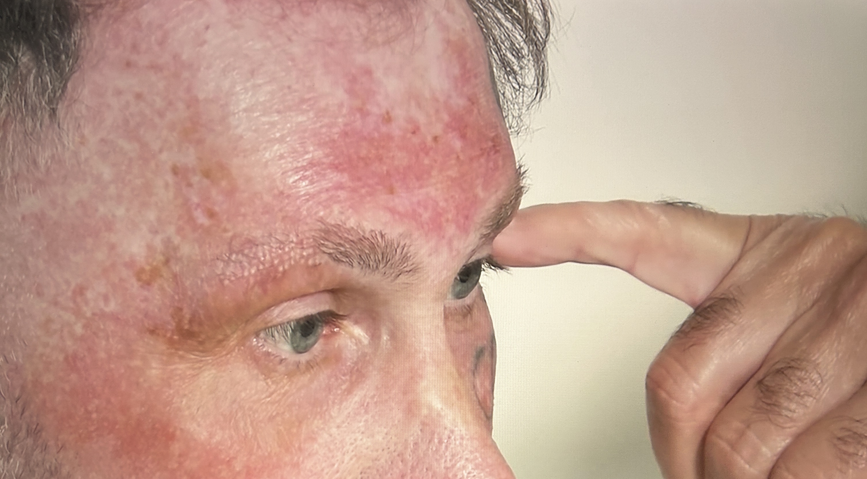 Close-up view of Terry Dunnage's eyebrow prior to eyebrow transplant surgery.