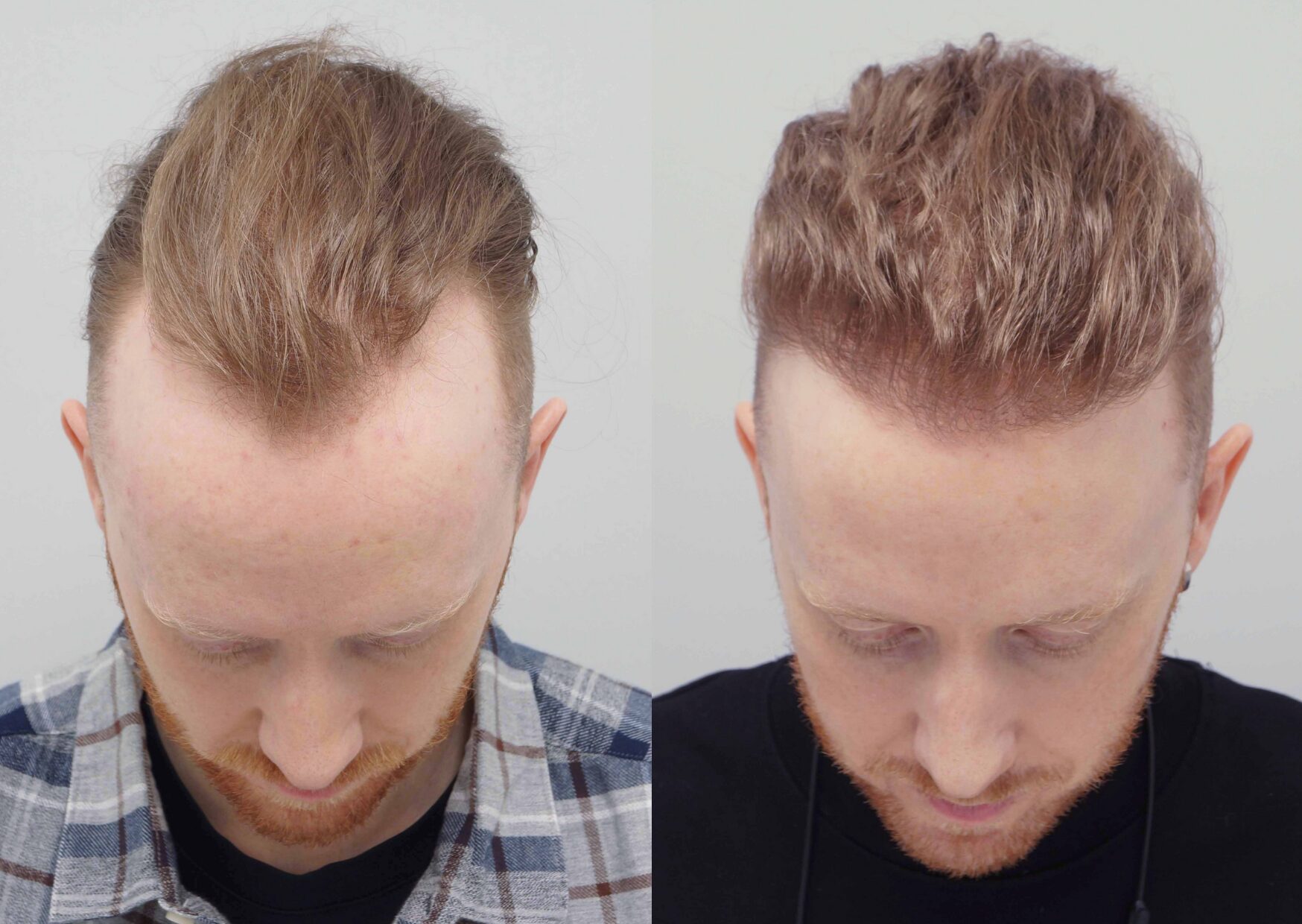 Before and after photo of a FUE hair transplant transplant on the hairline, performed at the Farjo Hair Institute