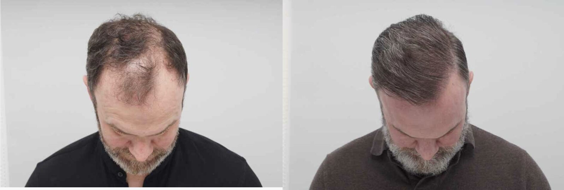 Before and after photo of FUE hair transplant