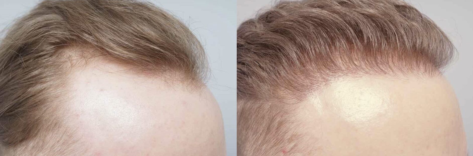 FUE hair transplant procedure before and after