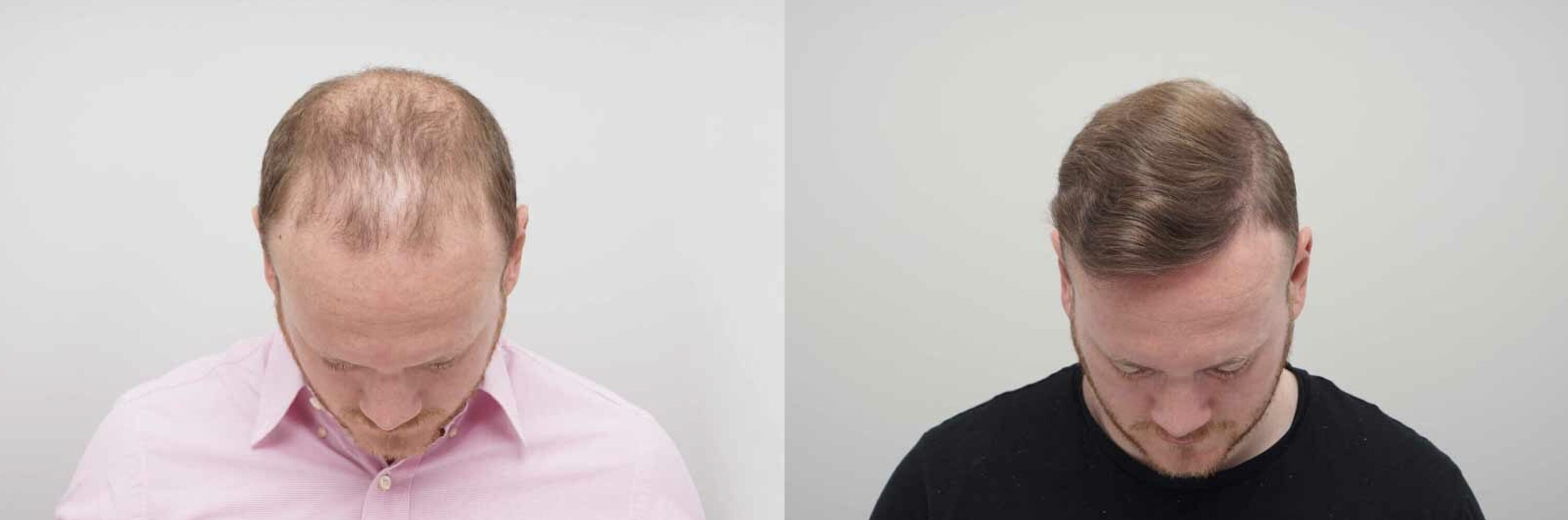 George Groves before and after FUE hair transplant surgery showing a now full head of hair 