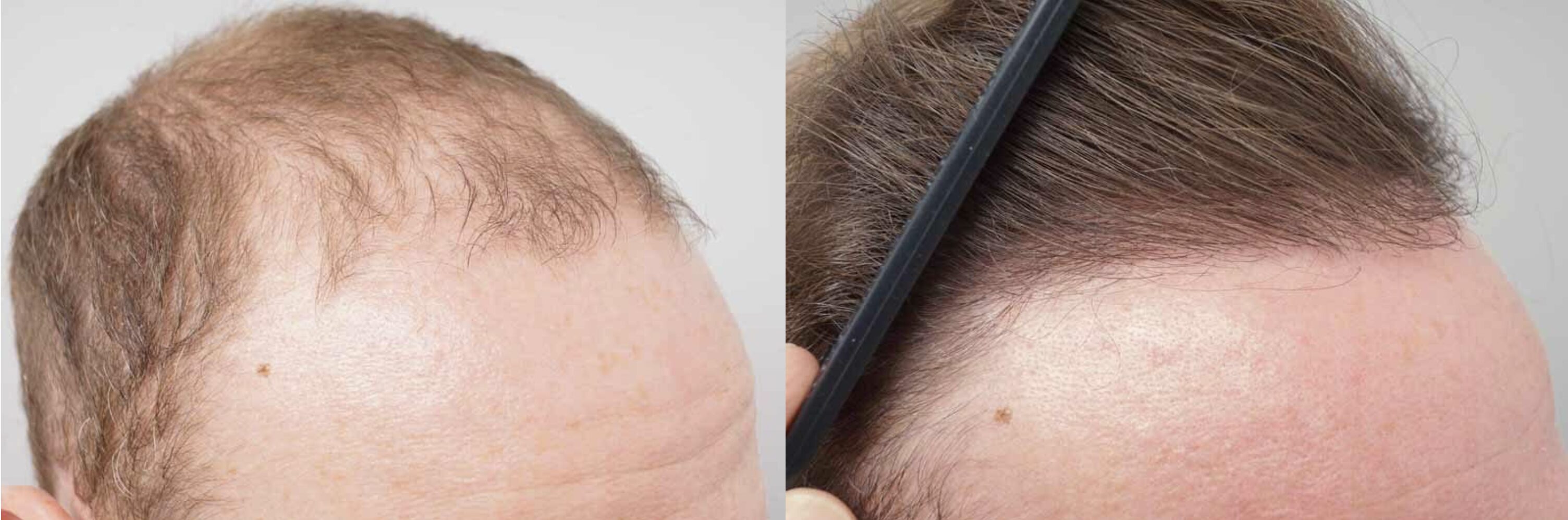 George Groves hairline hair transplant close up