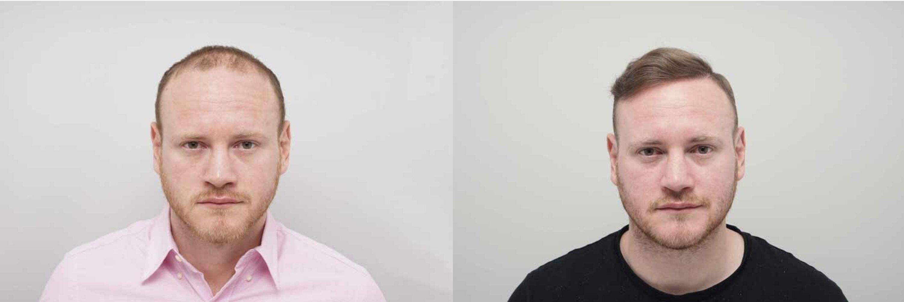 George Groves before and after hair transplant surgery 
