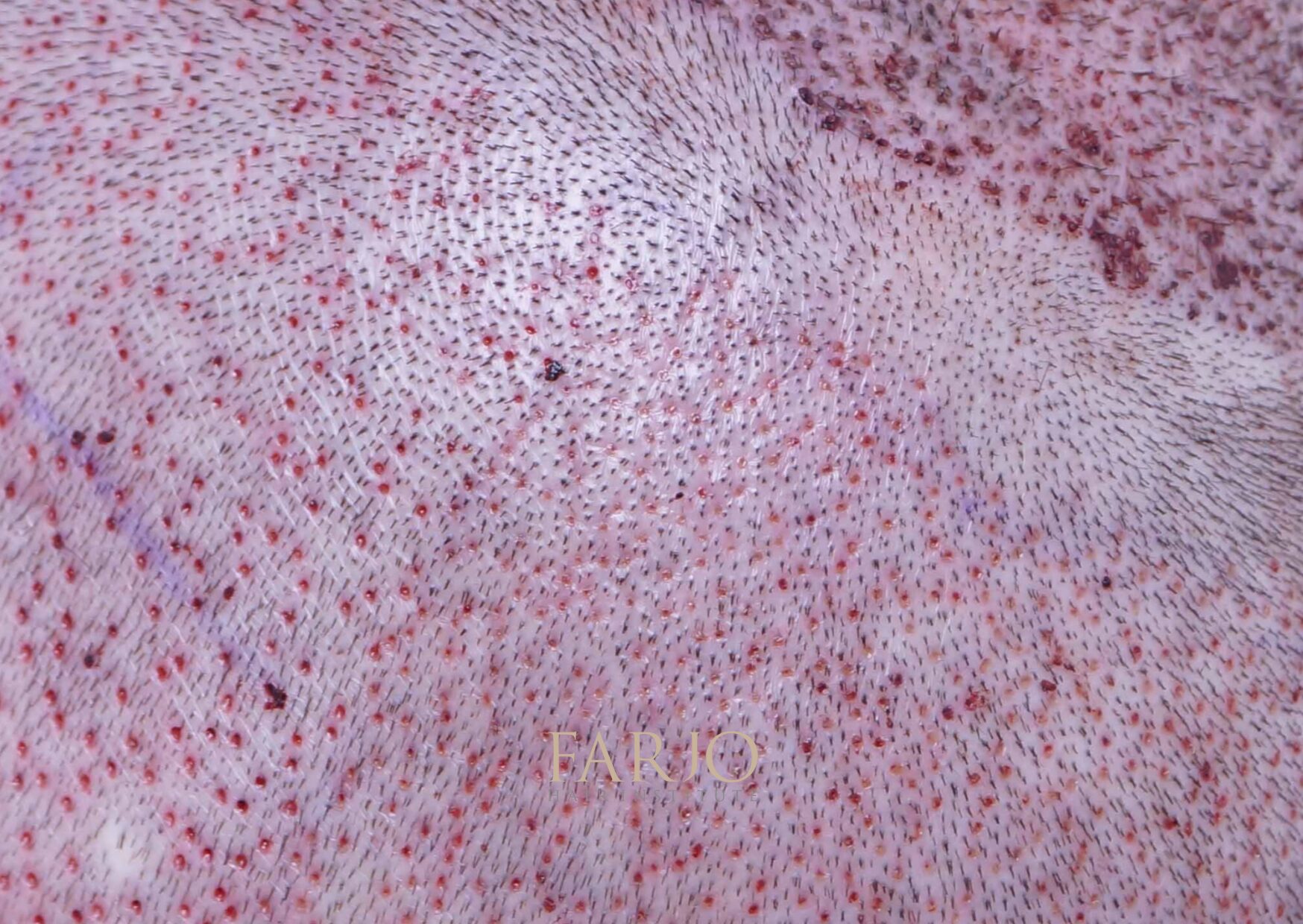 Scalp after a FUE hair transplant procedure
