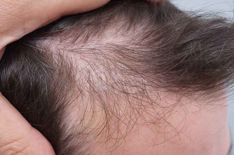 hair transplant before photo