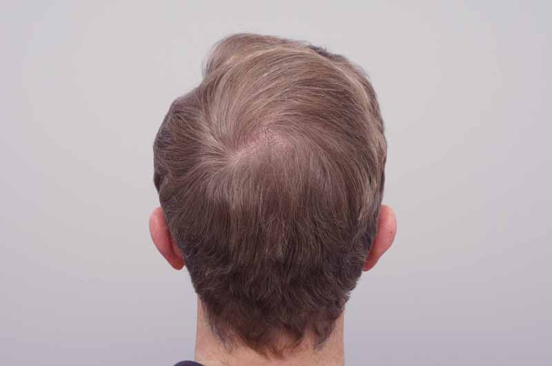 After photo of hair transplant surgery at the Farjo Hair Institute