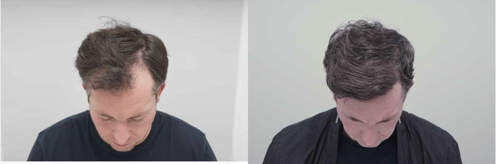 Robbie Fowler's hair transplant - before and after photos