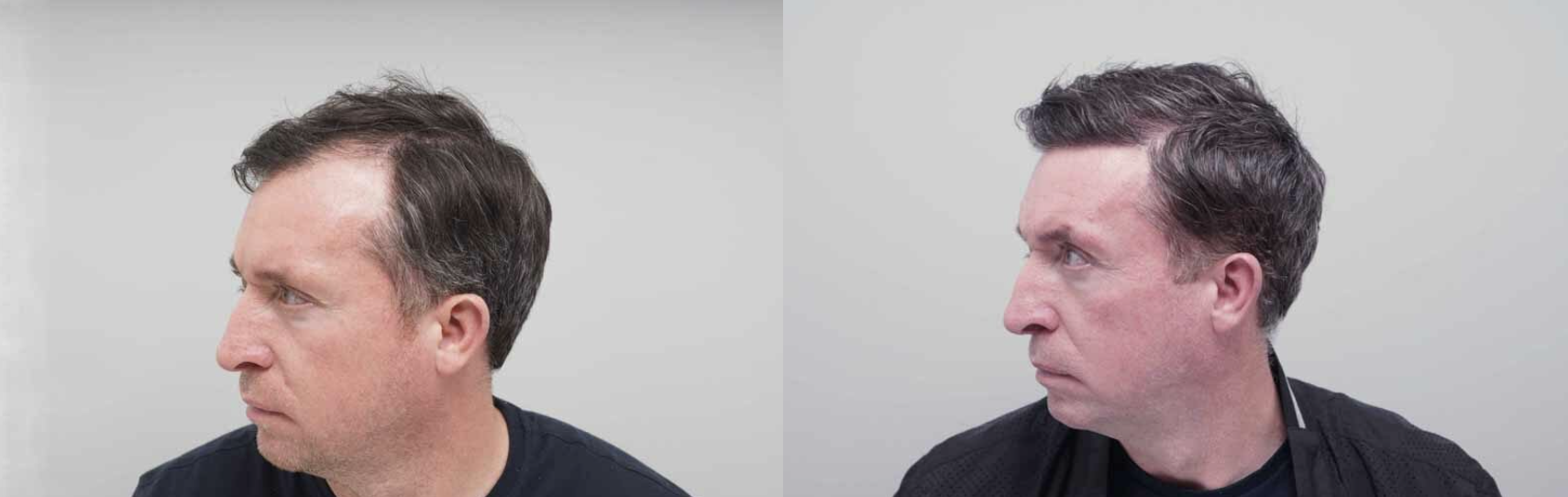 Robbie Fowler's hair transplant - before and after photos
