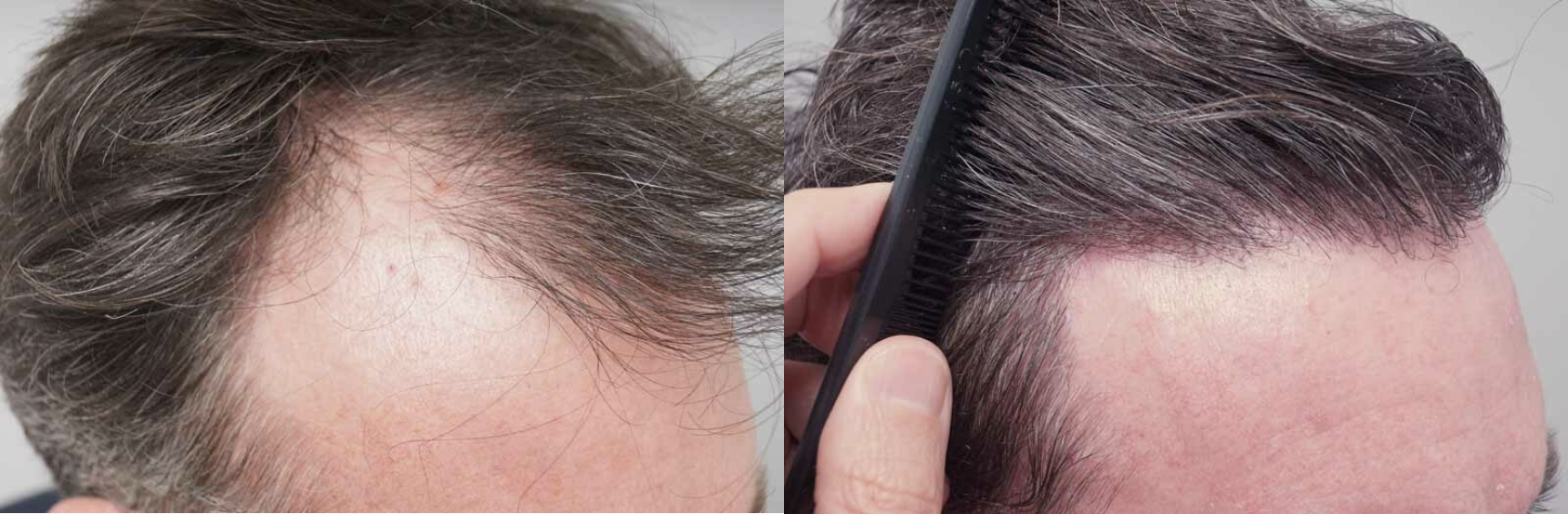 Robbie Fowler's hair transplant - before and after photos