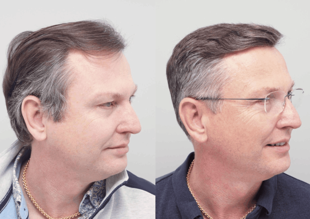 Stephen Dixon Hair Transplant - before and after photos