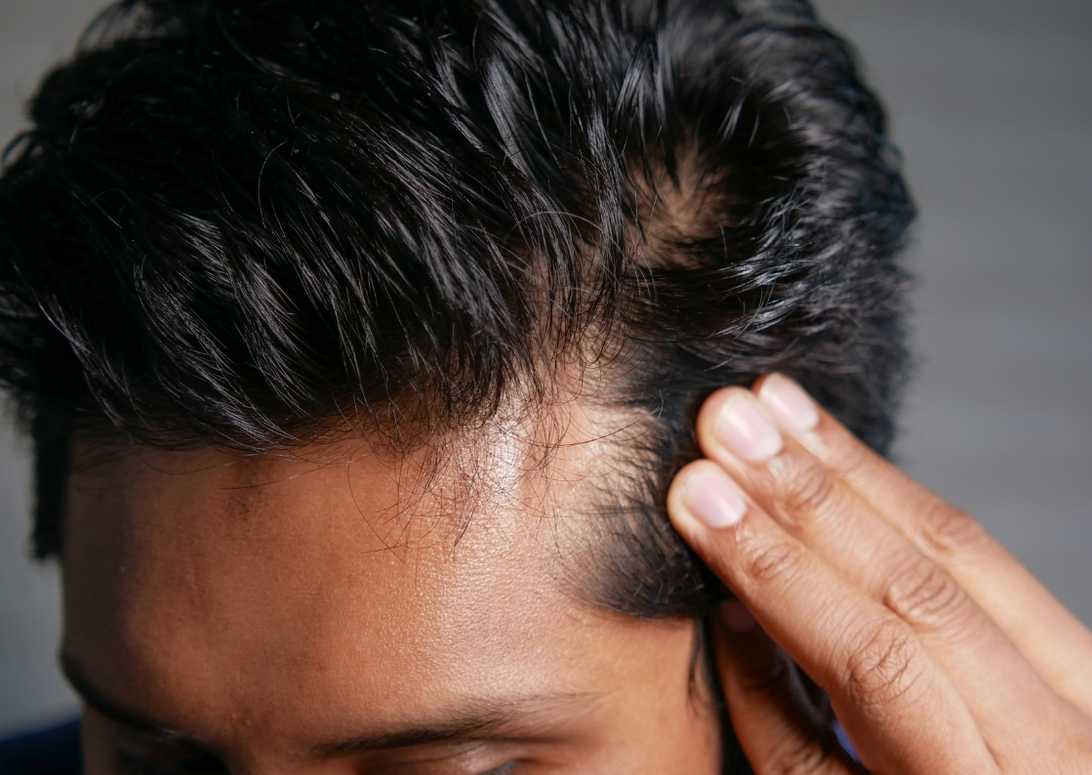 A young man inspecting his hairline and noticing early hair loss and temple receding.