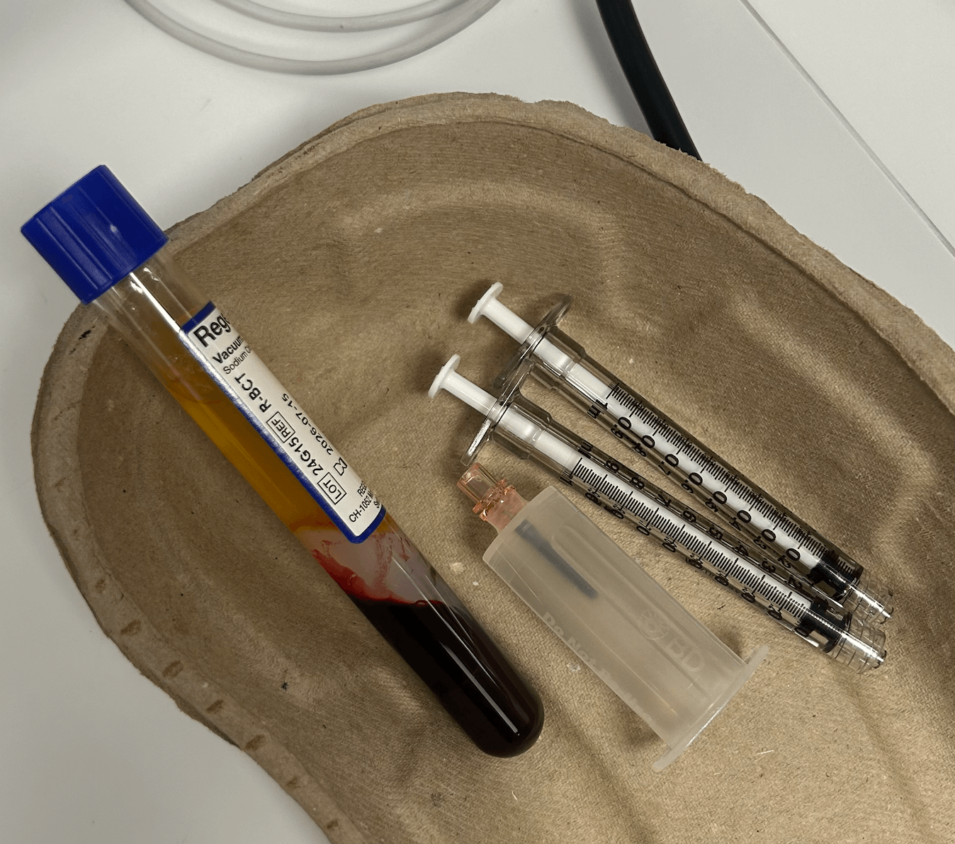 PRP blood sample and syringes, ready for hair loss treatment