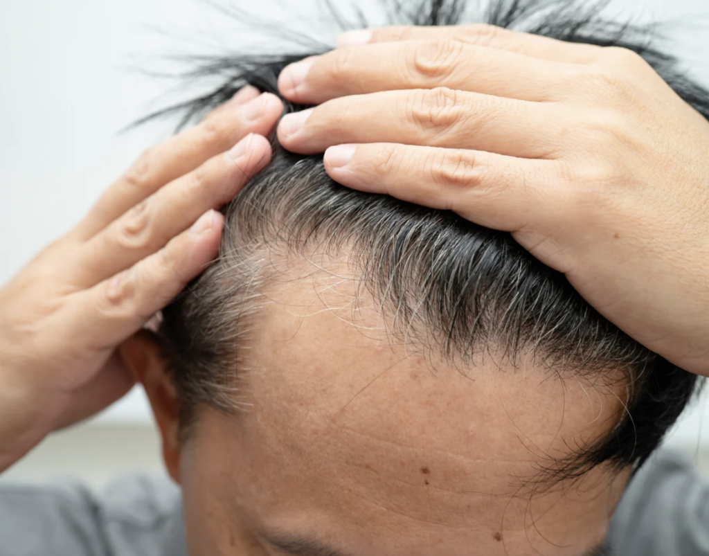 Man showing hair loss on his temples