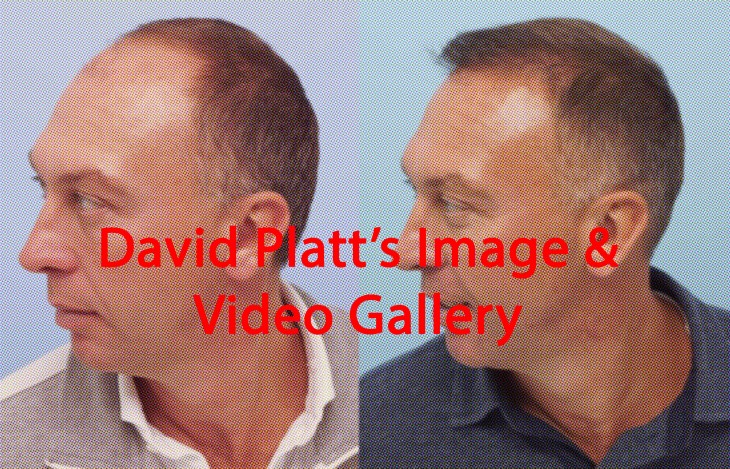ARTAS Robotic Hair Transplant for David Platt | Farjo Hair Institute ARTAS Robotic Hair Transplant for David Platt | Farjo Hair Institute